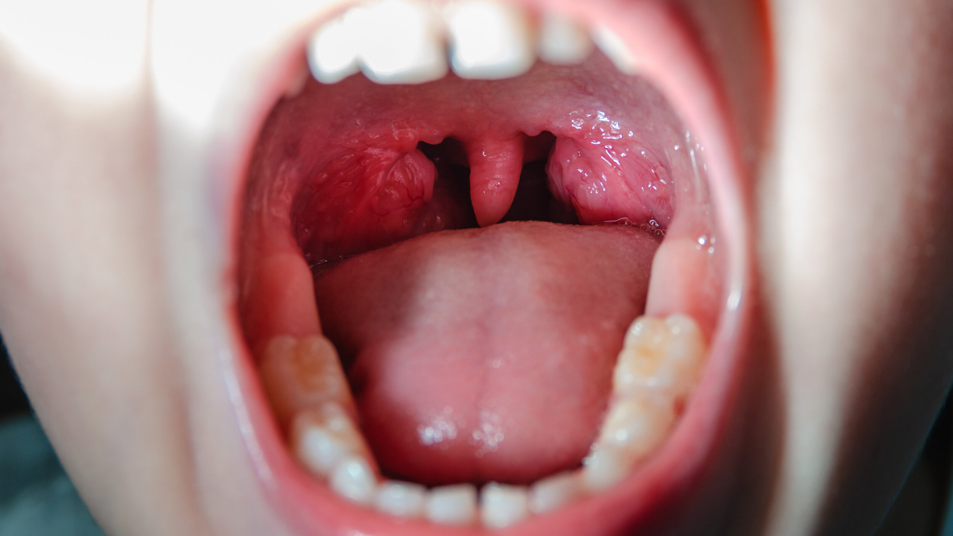 Amidan nằm ở đâu và chức năng của amidan trong hệ miễn dịch