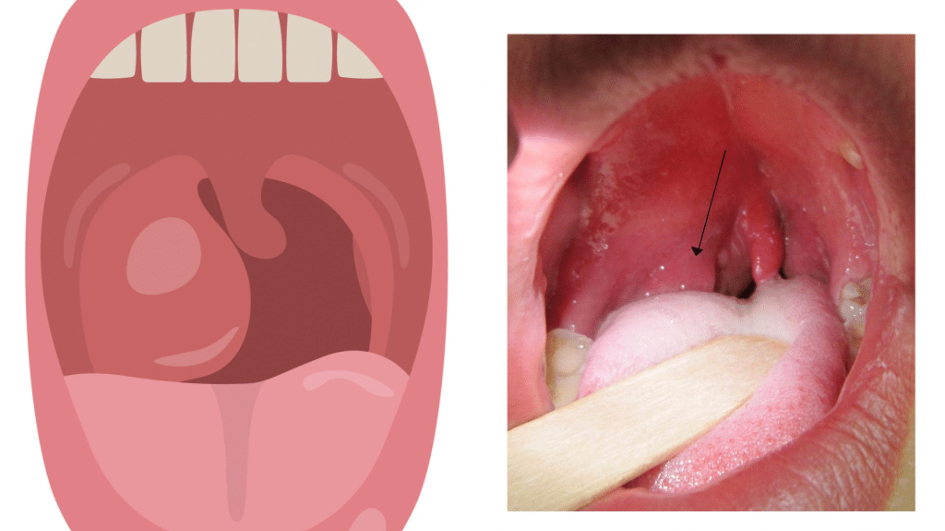Amidan nằm ở đâu và chức năng của amidan trong hệ miễn dịch 3