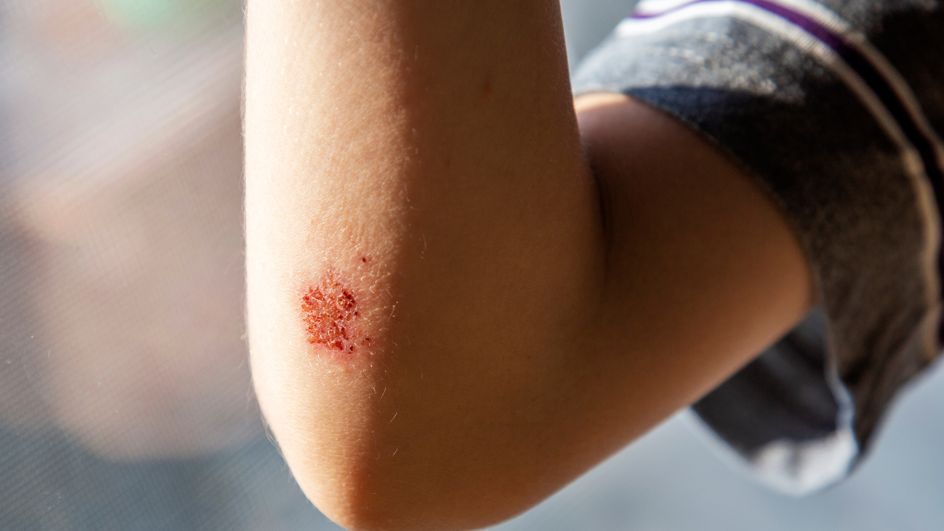 an-gi-cho-vet-thuong-mau-lanh-va-nhung-dieu-ban-can-biet 1.png