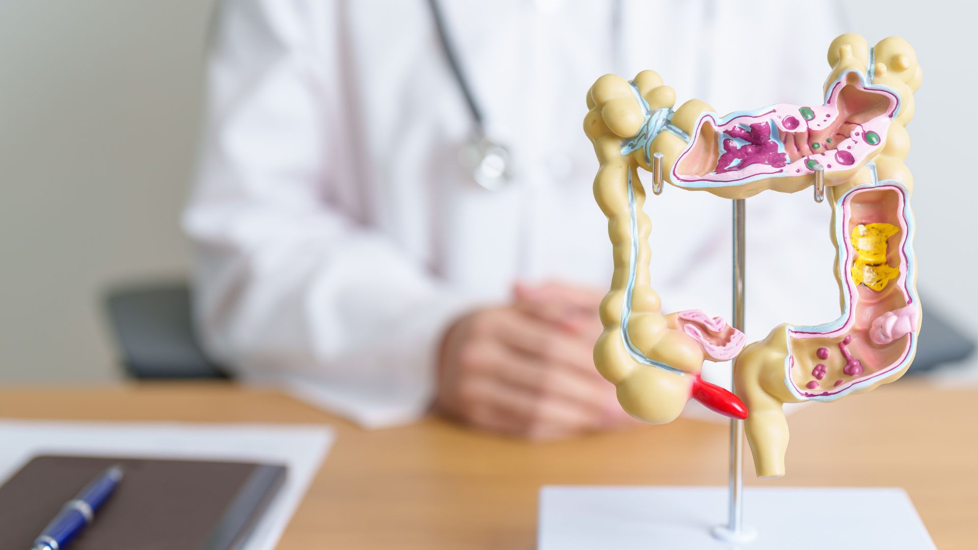 Viêm loét đại tràng là một nguyên nhân gây đau bụng dưới sau ăn