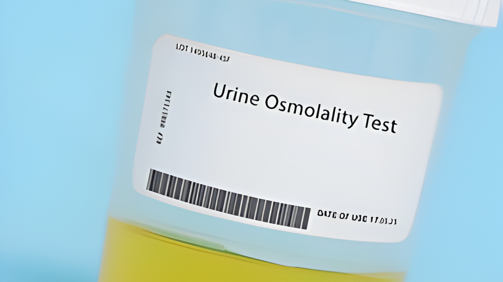 Áp lực thẩm thấu niệu, tên tiếng Anh là Urine osmolality, là chỉ số đo nồng độ các chất hòa tan có trong nước tiểu