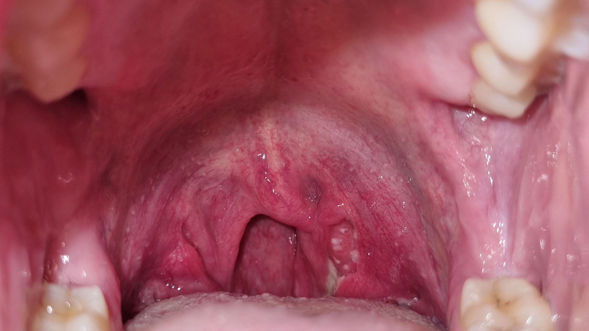 Áp xe amidan là tình trạng hình thành một ổ mủ khu trú ở vùng quanh amidan