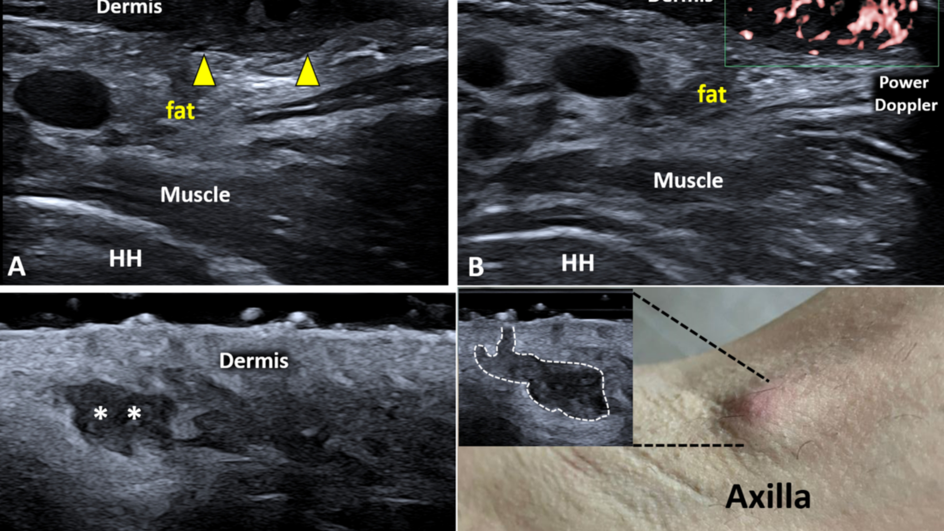 Siêu âm áp xe nách