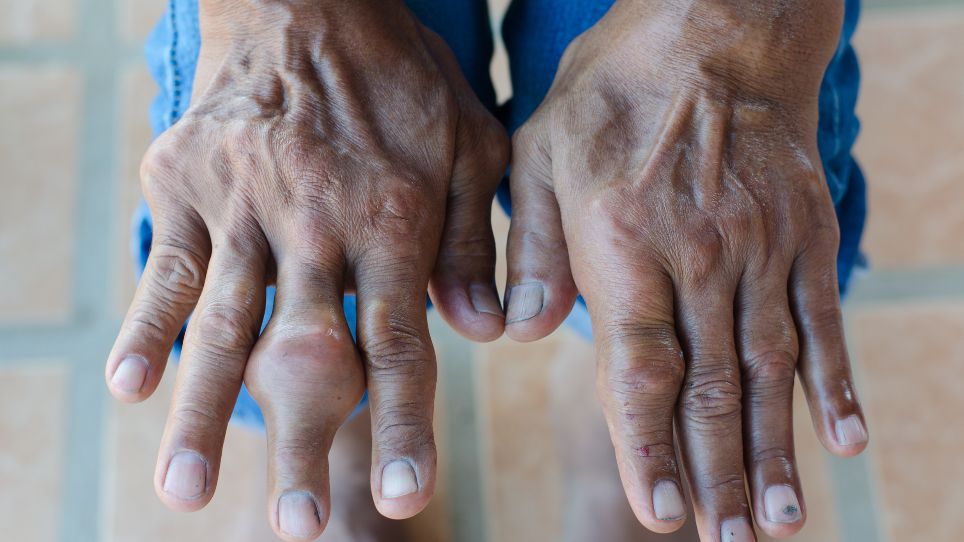 Người có tiền sử&nbsp;bệnh gout hoặc gia đình có người mắc gout cần theo dõi định kỳ