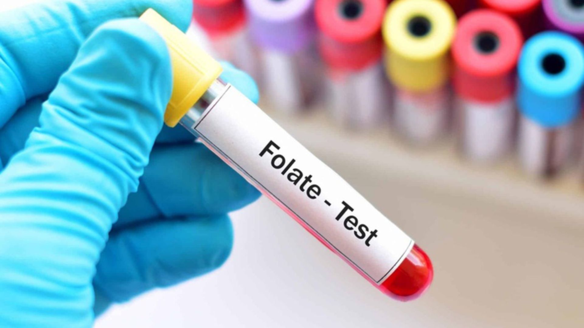 Bác sĩ có thể chỉ định xét nghiệm acid folic để chẩn đoán thiếu máu