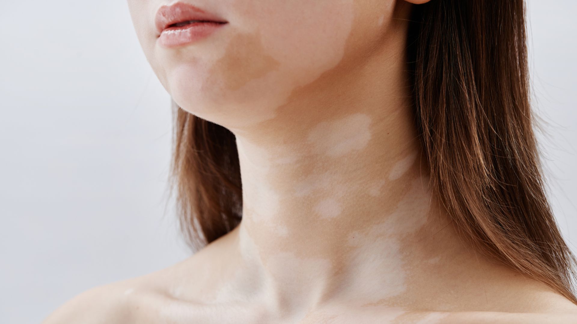 Xuất hiện các đốm trắng hoặc mảng sắc tố là biểu hiện đặc trưng của bạch biến