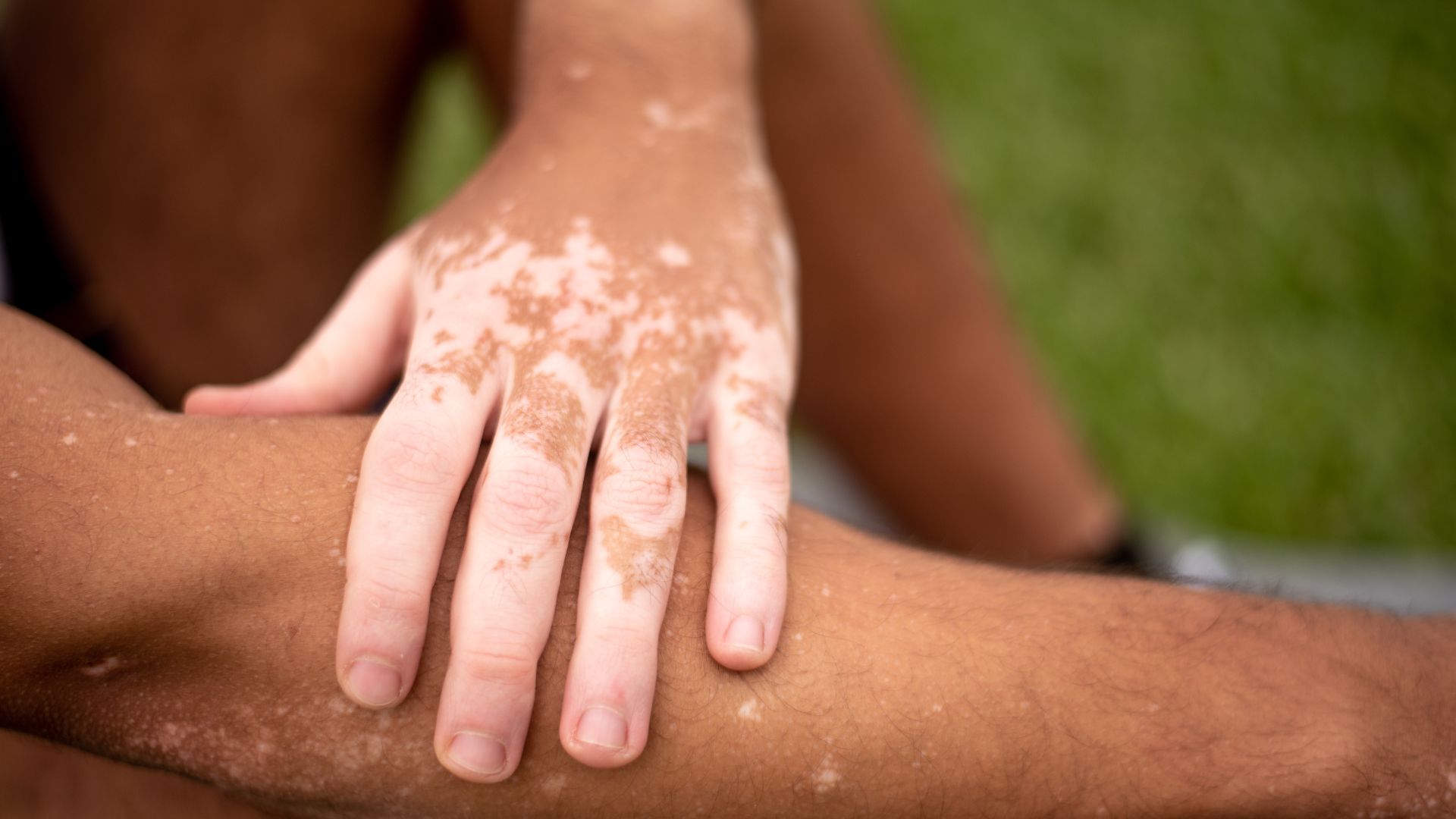 Bệnh bạch biến có nguy hiểm không