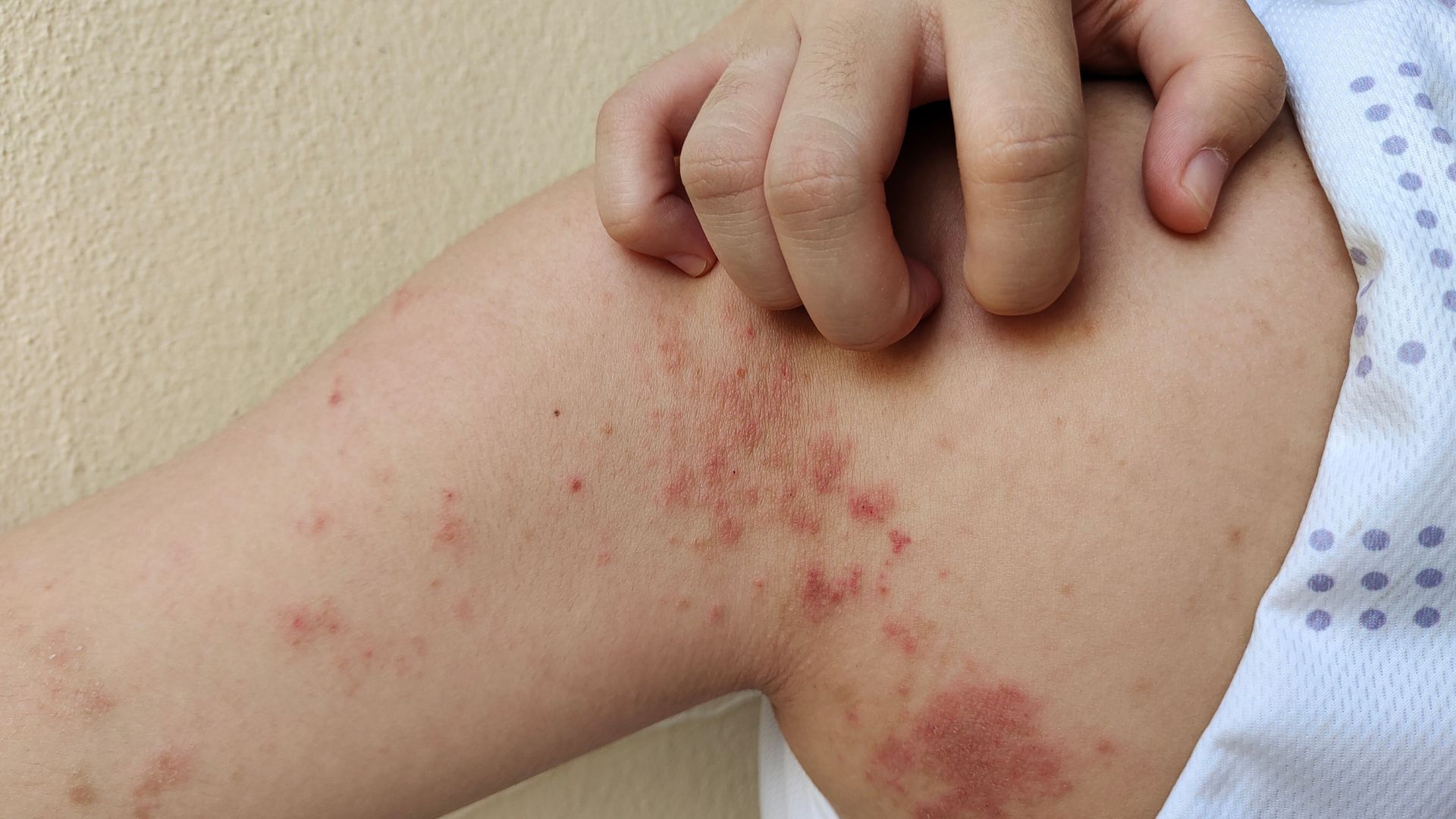 Bạch cầu ái kiềm tăng cao có thể liên quan đến dị ứng và viêm mạn tính