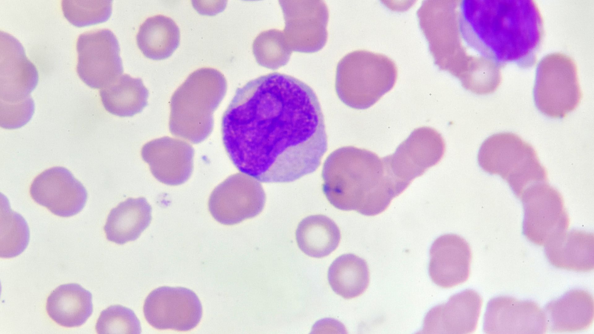 Bạch cầu cấp là một dạng ung thư máu do tế bào non phát triển và phân chia bất thường