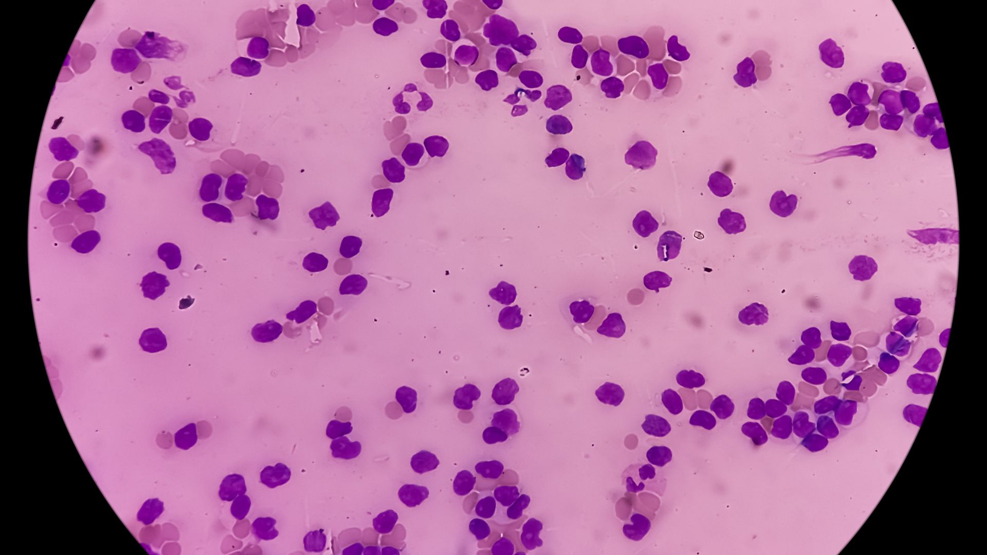 Bạch cầu lympho tăng là gì? Nguyên nhân, triệu chứng và cách điều trị hiệu quả 1