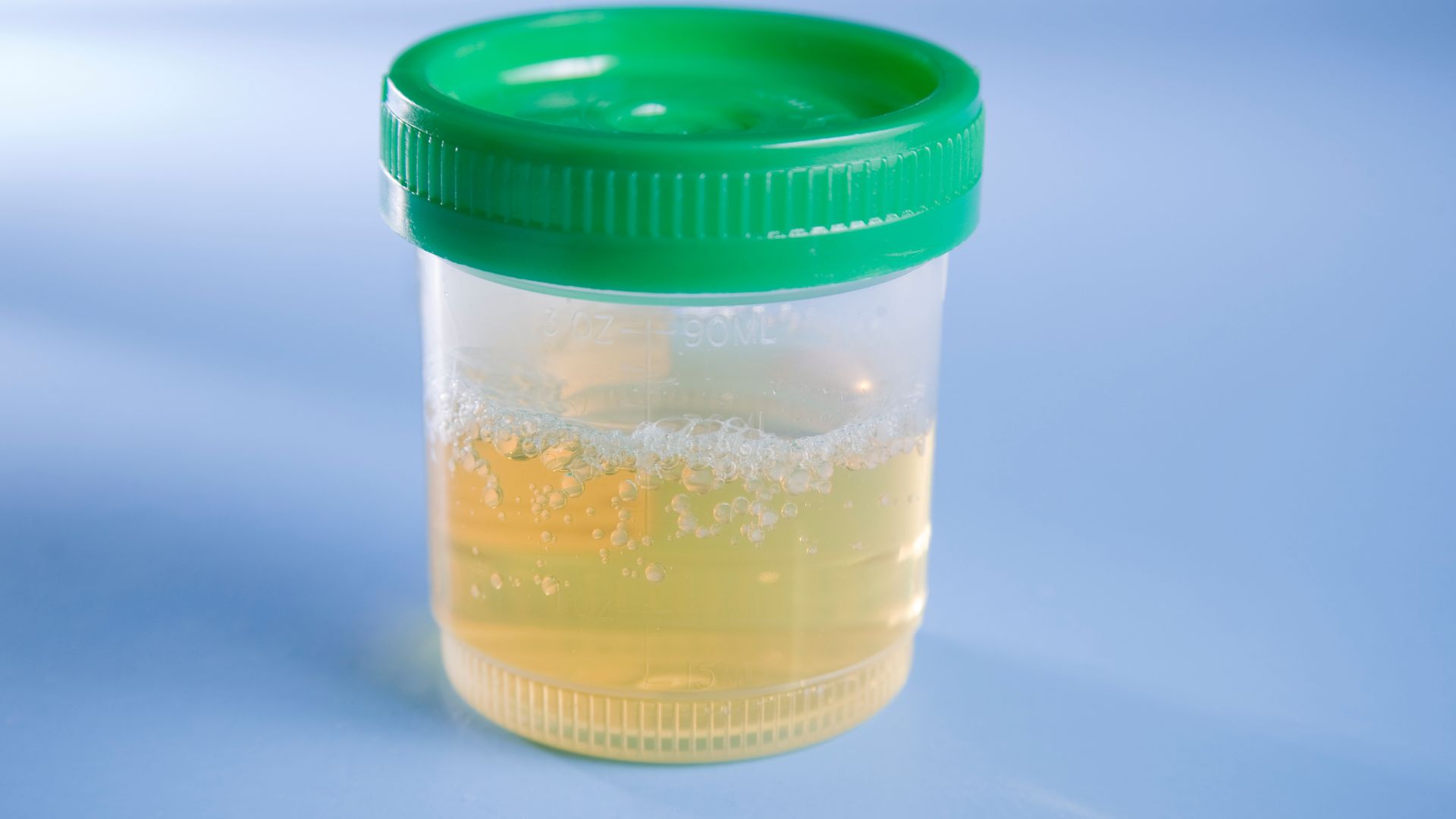 Nước tiểu đục và có mùi lạ là một dấu hiệu của bạch cầu niệu