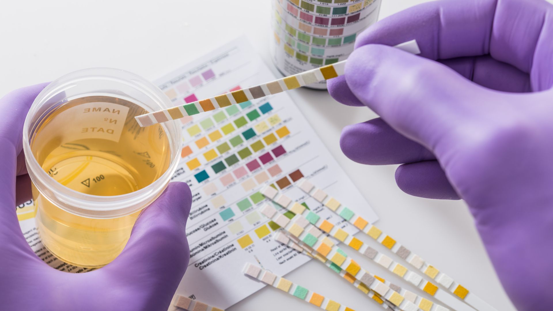 Xét nghiệm nước tiểu giúp phát hiện sớm bạch cầu niệu