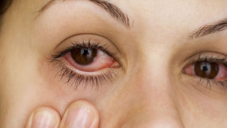 Bạch hầu ở mắt là một thể nhiễm trùng hiếm gặp do vi khuẩn Corynebacterium diphtheriae gây ra