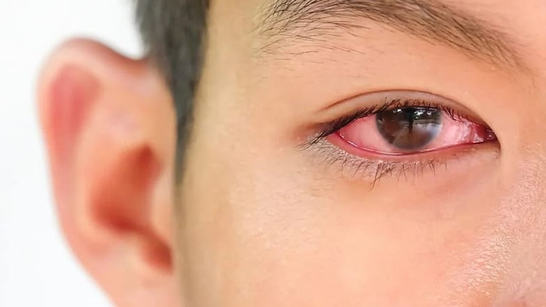 Sưng đỏ và đau mắt là một trong các dấu hiệu nhận biết bạch hầu ở mắt