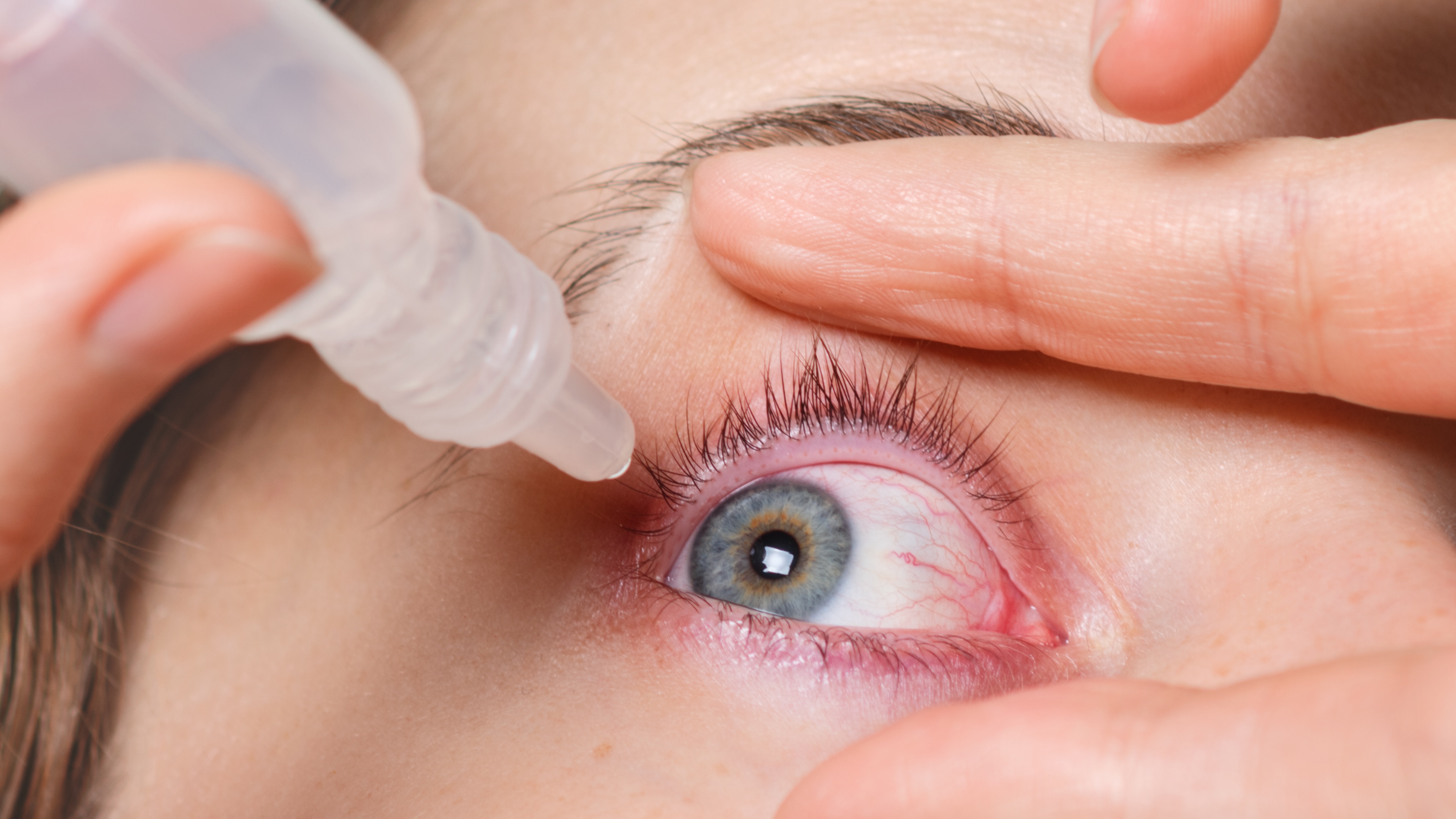 Bạch hầu ở mắt cần được điều trị sớm và đúng phác đồ để ngăn ngừa biến chứng