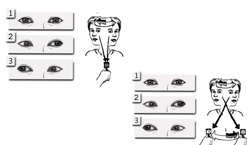 Bài tập nhìn đuổi theo chữa rối loạn tiền đình