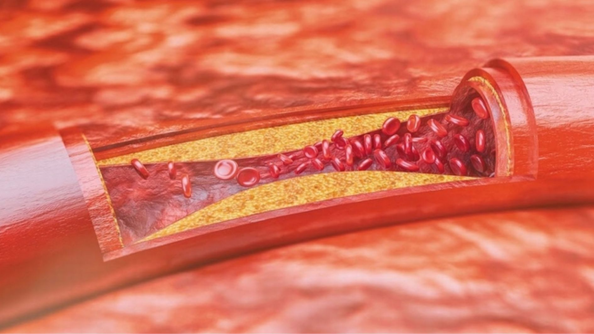 Xơ vữa động mạch gây tình trạng bàn chân lạnh