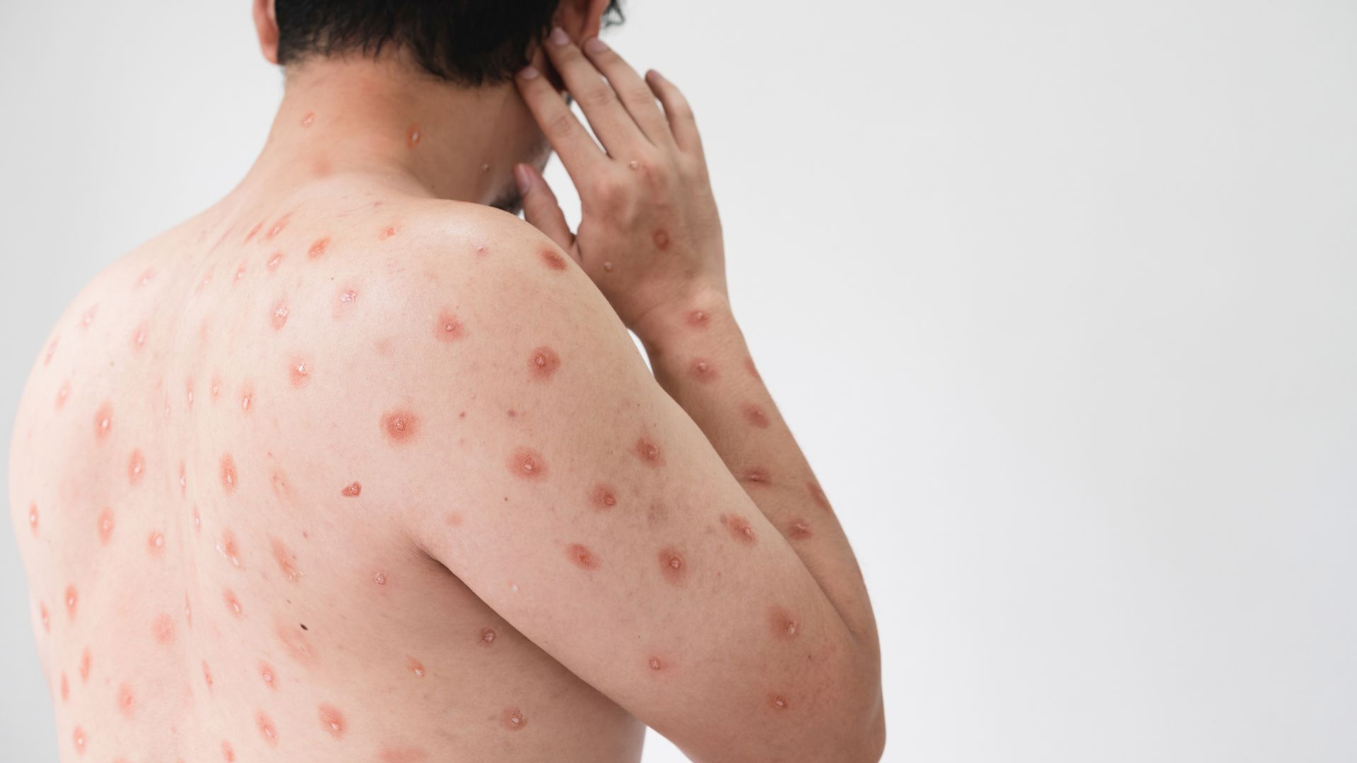 Ban đỏ nhiễm khuẩn thường nhầm lẫn với các bệnh về da khác