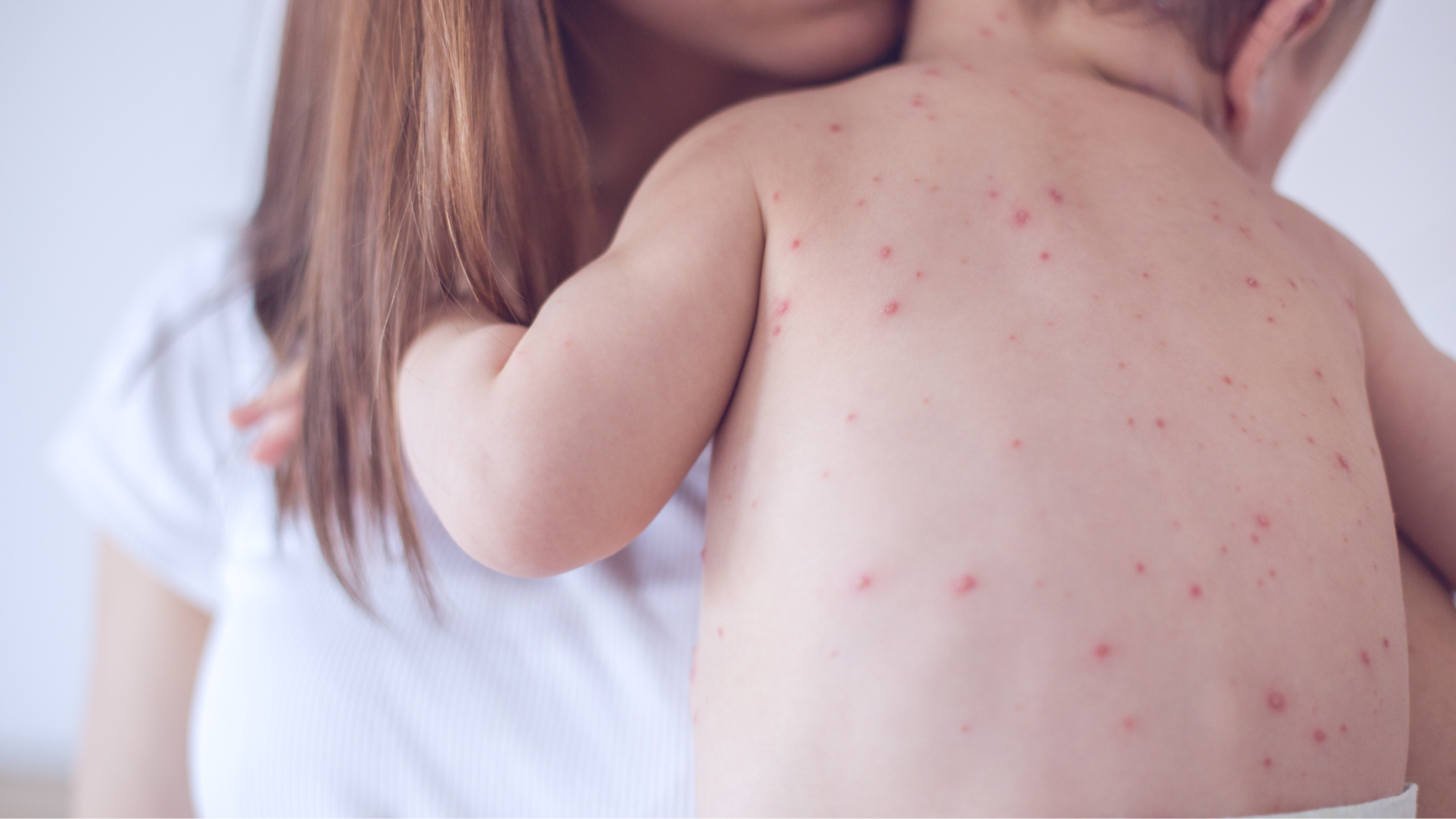 ban-soi-va-ban-rubella-khac-nhau-nhu-the-nao-bien-phap-phong-benh-hieu-qua (1).png