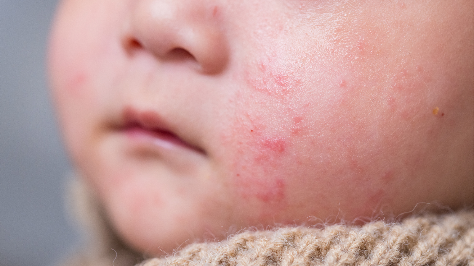 Trẻ mắc bệnh chàm có thể gặp triệu chứng sưng viêm tại vùng kín như một phần của bệnh