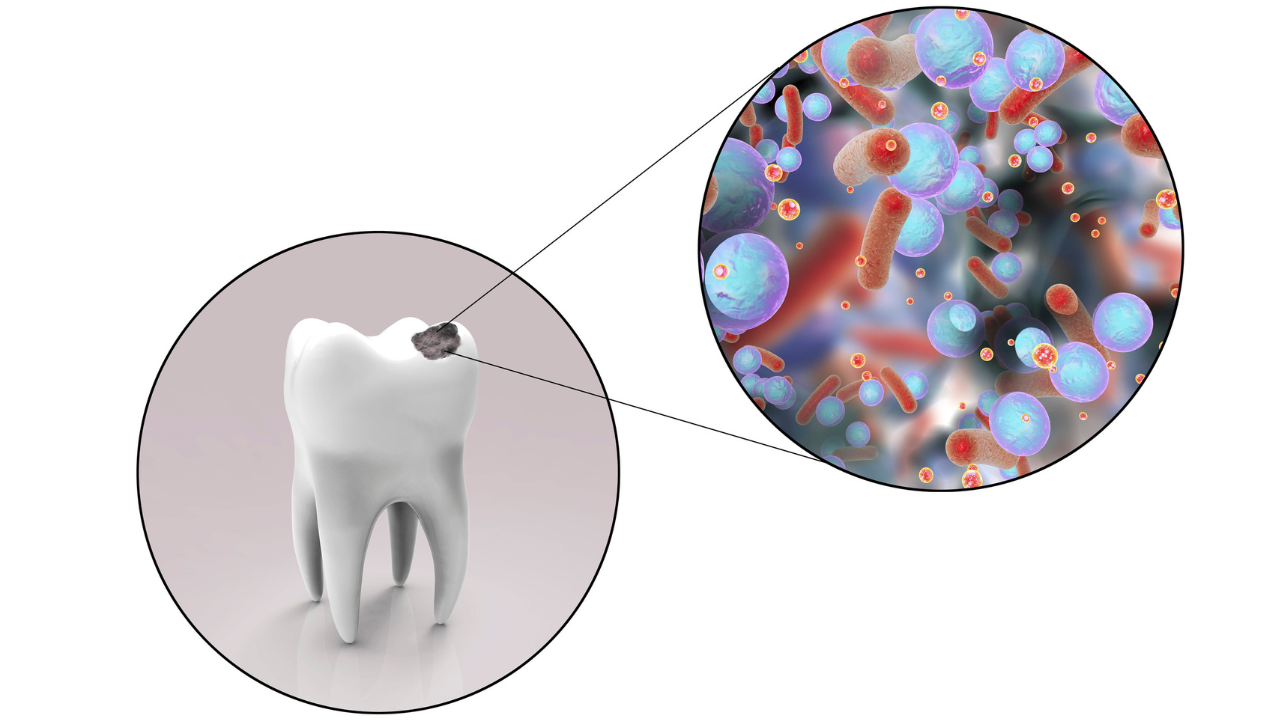 Sâu răng hàm giai đoạn 3 vi khuẩn đã tấn công đến tủy răng