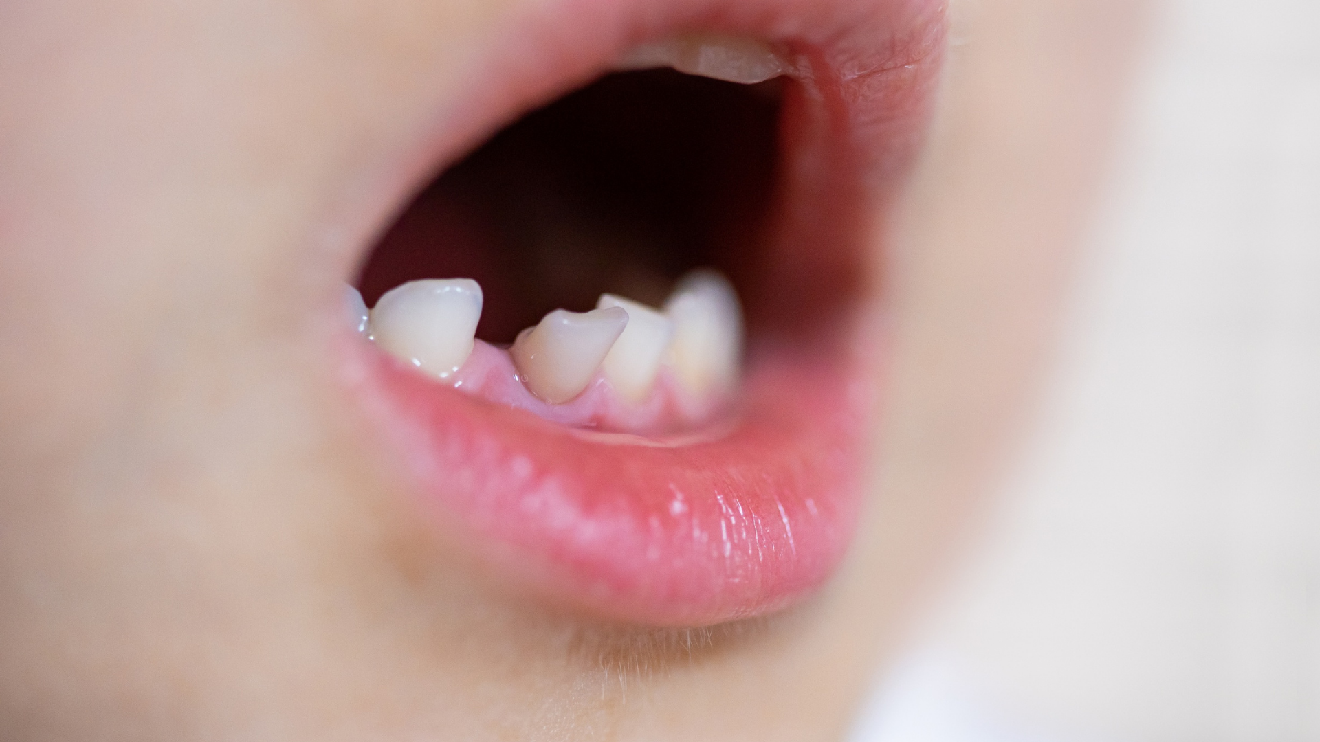 Tìm nguyên nhân giúp hiểu rõ bé 5 tuổi thay răng sữa có sớm không?