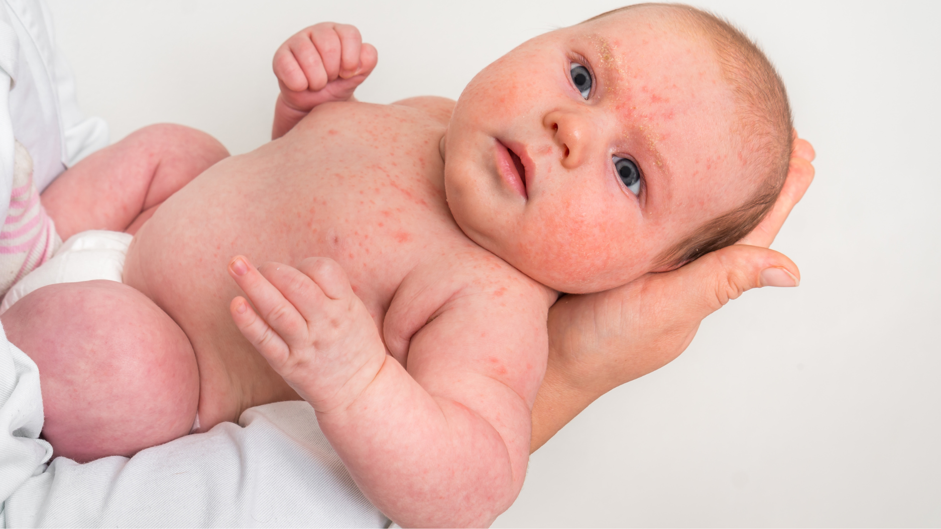 be-bi-phat-ban-sau-khi-tiem-phong-soi-co-nguy-hiem-khong (1).png