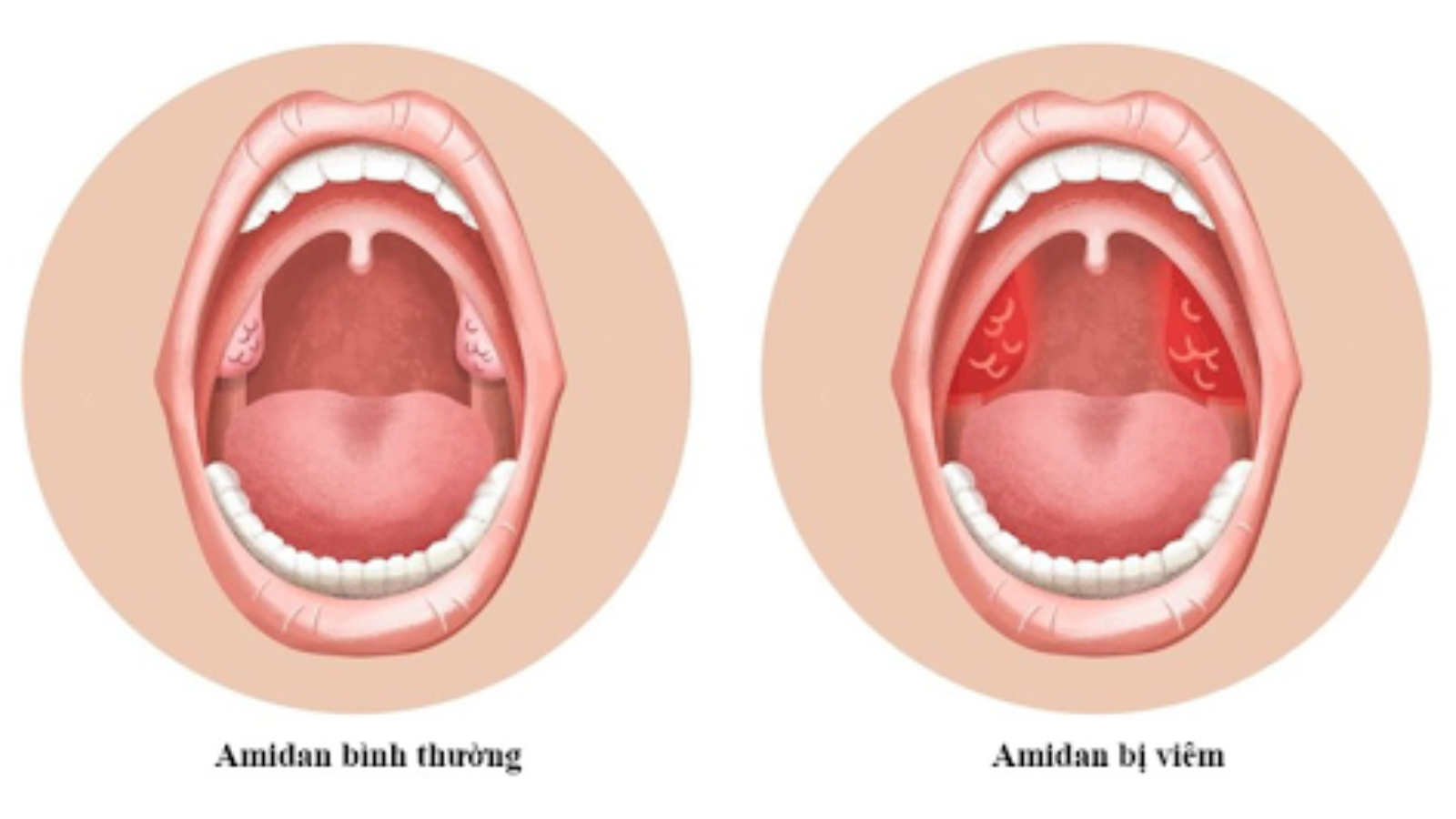 Bé thường dễ bị viêm amidan do hệ miễn dịch chưa hoàn chỉnh