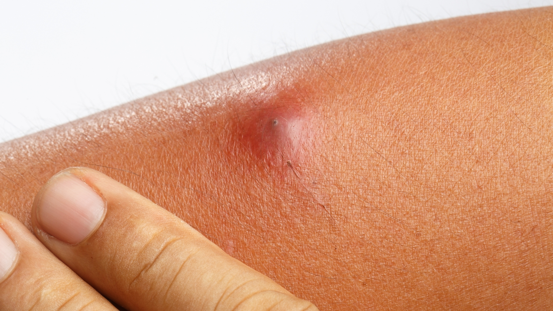 Dấu hiệu đầu tiên thường gặp của áp xe da là sự xuất hiện của một khối sưng cục bộ, lớn dần theo thời gian