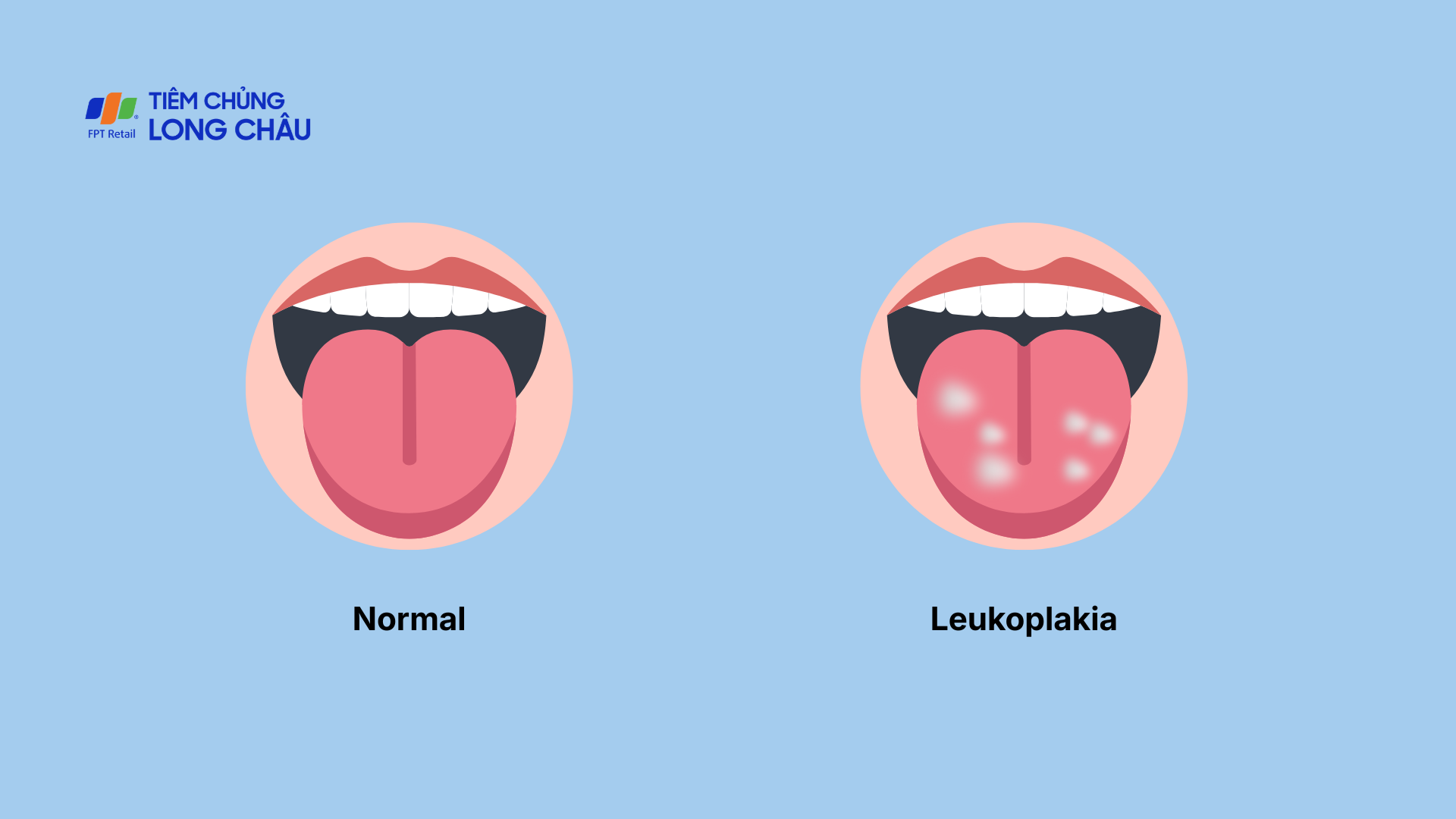 Dấu hiệu của bạch sản là các tổn thương màu trắng xuất hiện trong khoang miệng