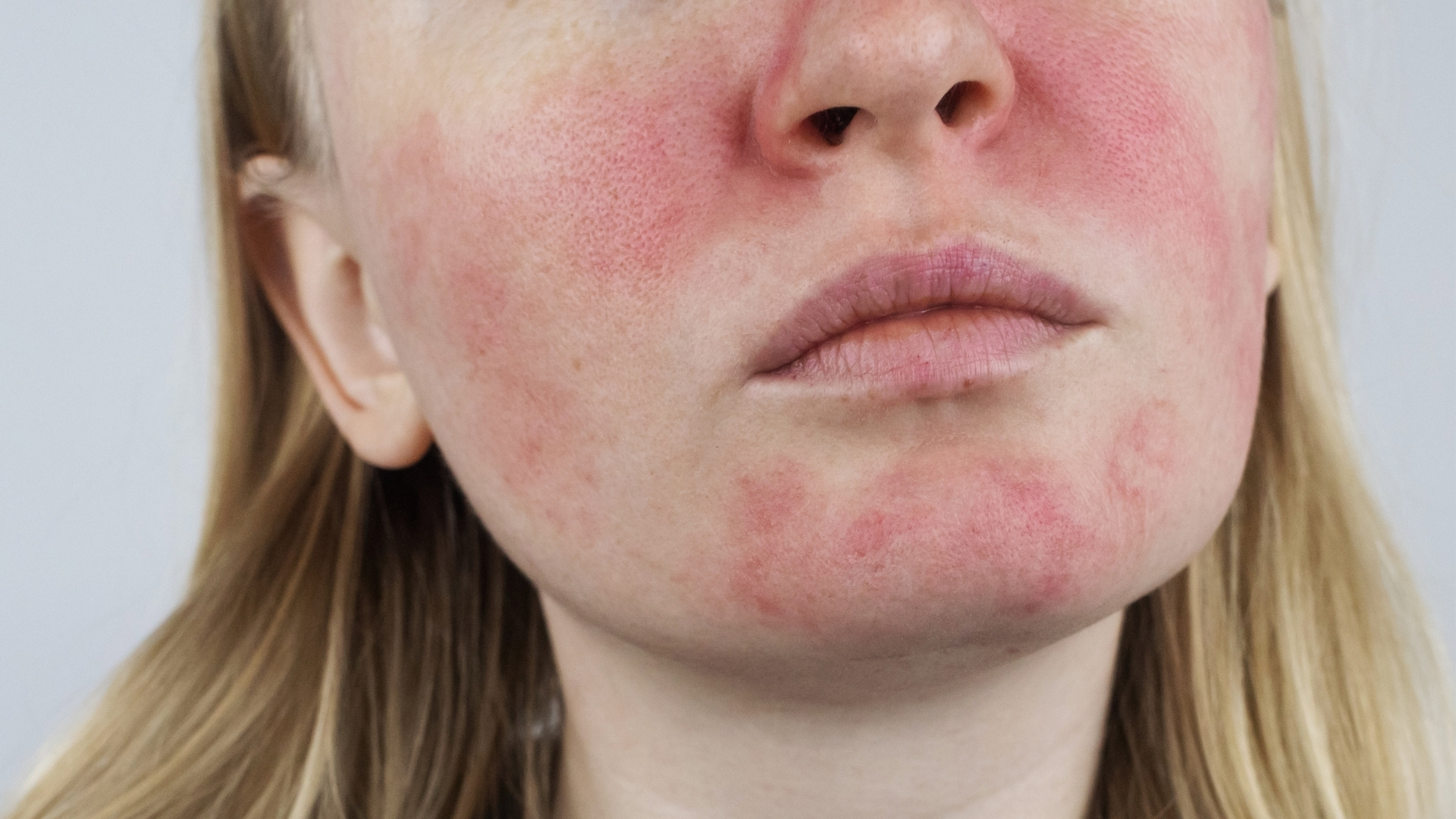 Đỏ da kéo dài ở má, mũi, trán hoặc cằm là dấu hiệu phổ biến của bệnh Rosacea