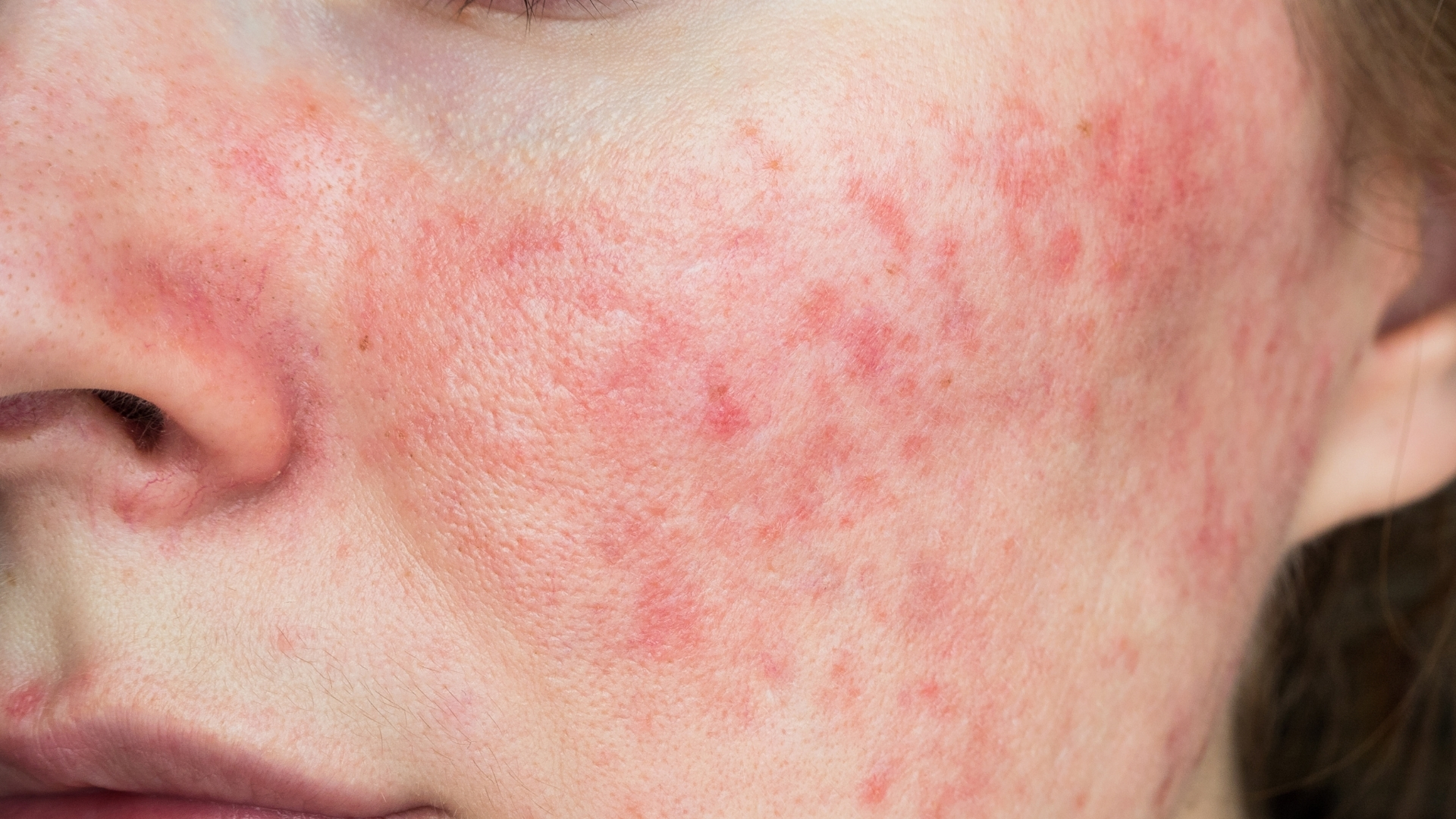 Nguyên nhân chính xác của Rosacea hiện vẫn chưa được xác định rõ ràng
