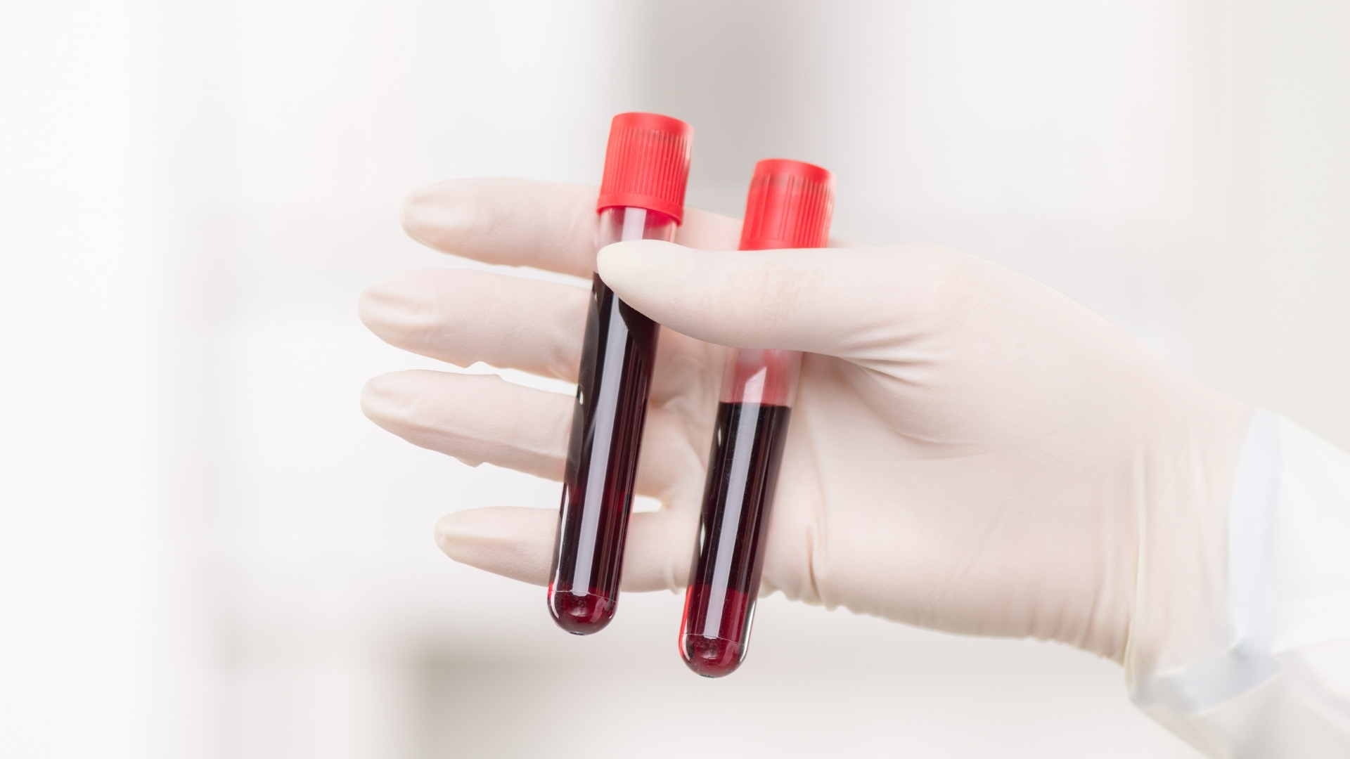 Trong những trường hợp nghi ngờ bệnh lý khác, bác sĩ có thể chỉ định thêm các xét nghiệm máu