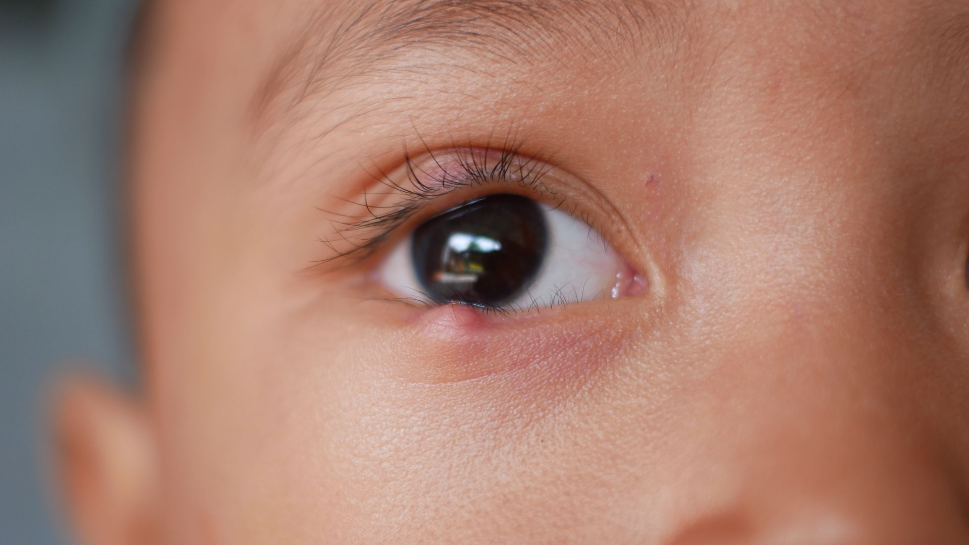 Xuất hiện khối u nhỏ tròn, chắc, nằm trong mi hoặc gần bờ mi, kích thước có thể tăng dần theo thời gian