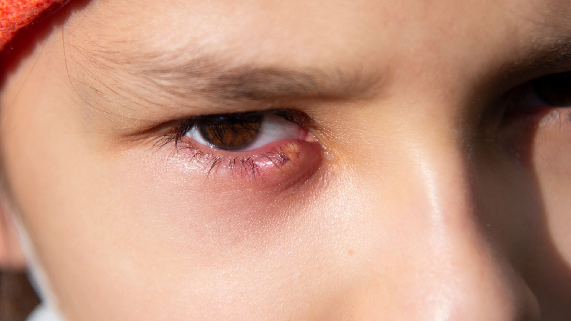 Lỗ tuyến Meibomius bị bít do chất nhờn đặc hoặc tế bào chết tích tụ sẽ gây chắp mắt