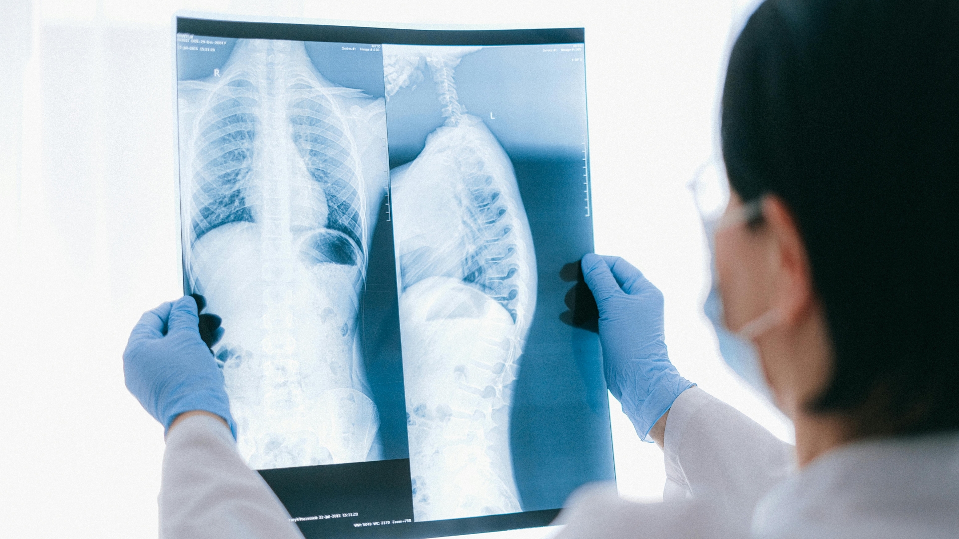 X-quang cột sống là phương tiện hình ảnh học cơ bản giúp phát hiện các bất thường về cấu trúc