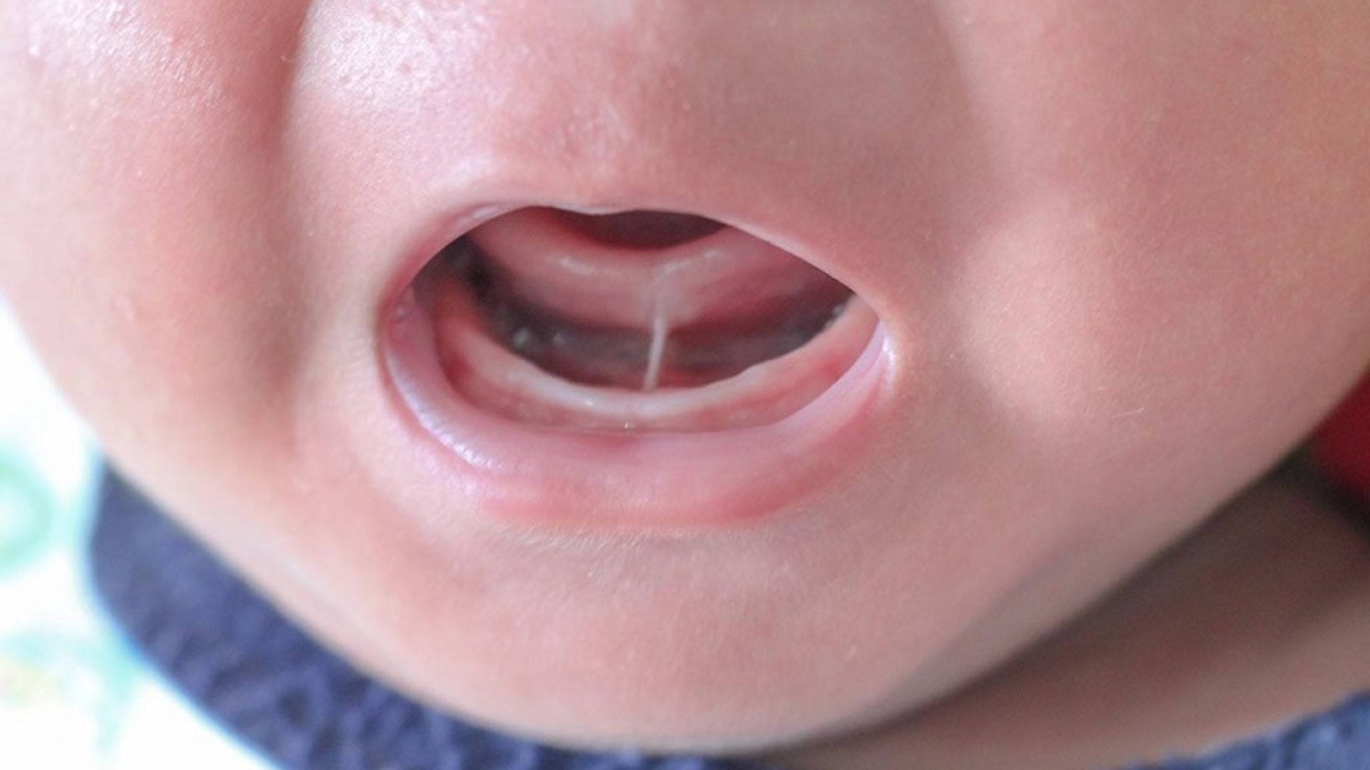 Thắng lưỡi bám gần đầu lưỡi ở trẻ bị dính thắng lưỡi