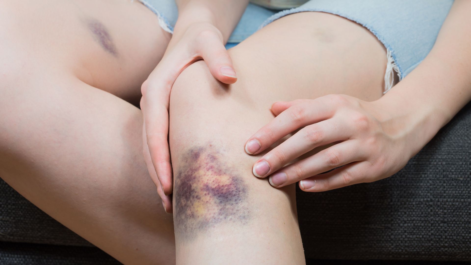 Do giảm tiểu cầu, người bệnh có thể dễ bị bầm tím không rõ nguyên nhân hoặc chảy máu cam, chảy máu chân răng