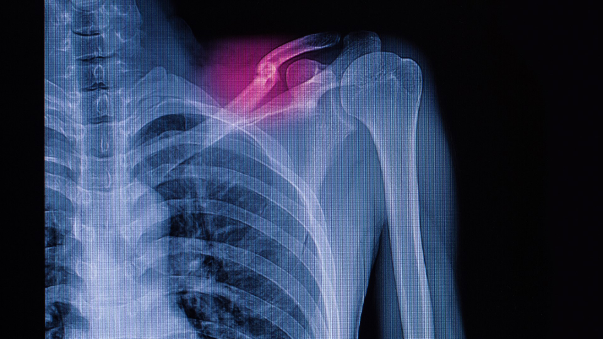 Gãy xương đòn có thể gây đau chói tại chỗ gãy