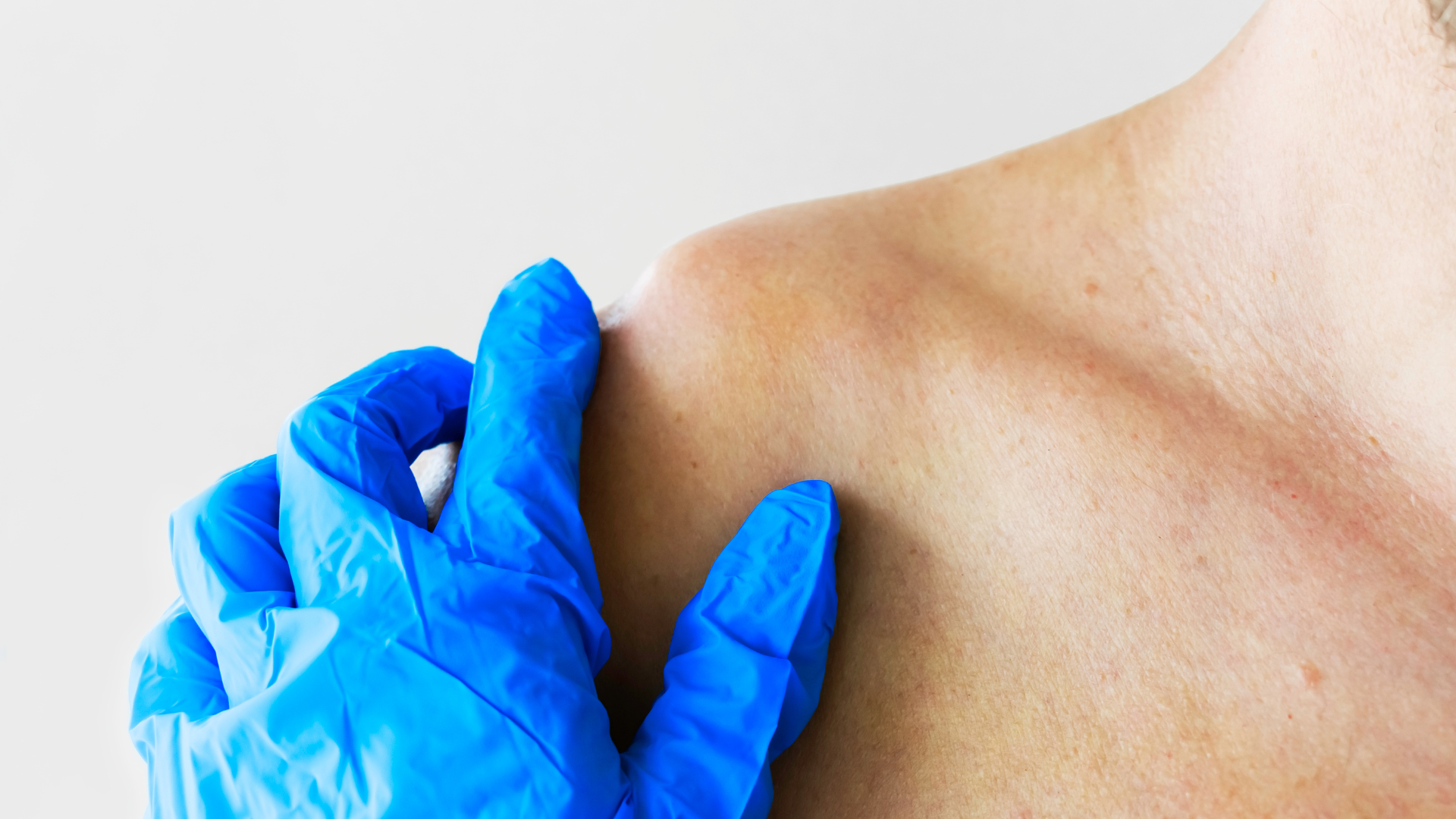 Người bệnh nên đi khám ngay khi phát hiện gãy xương đòn