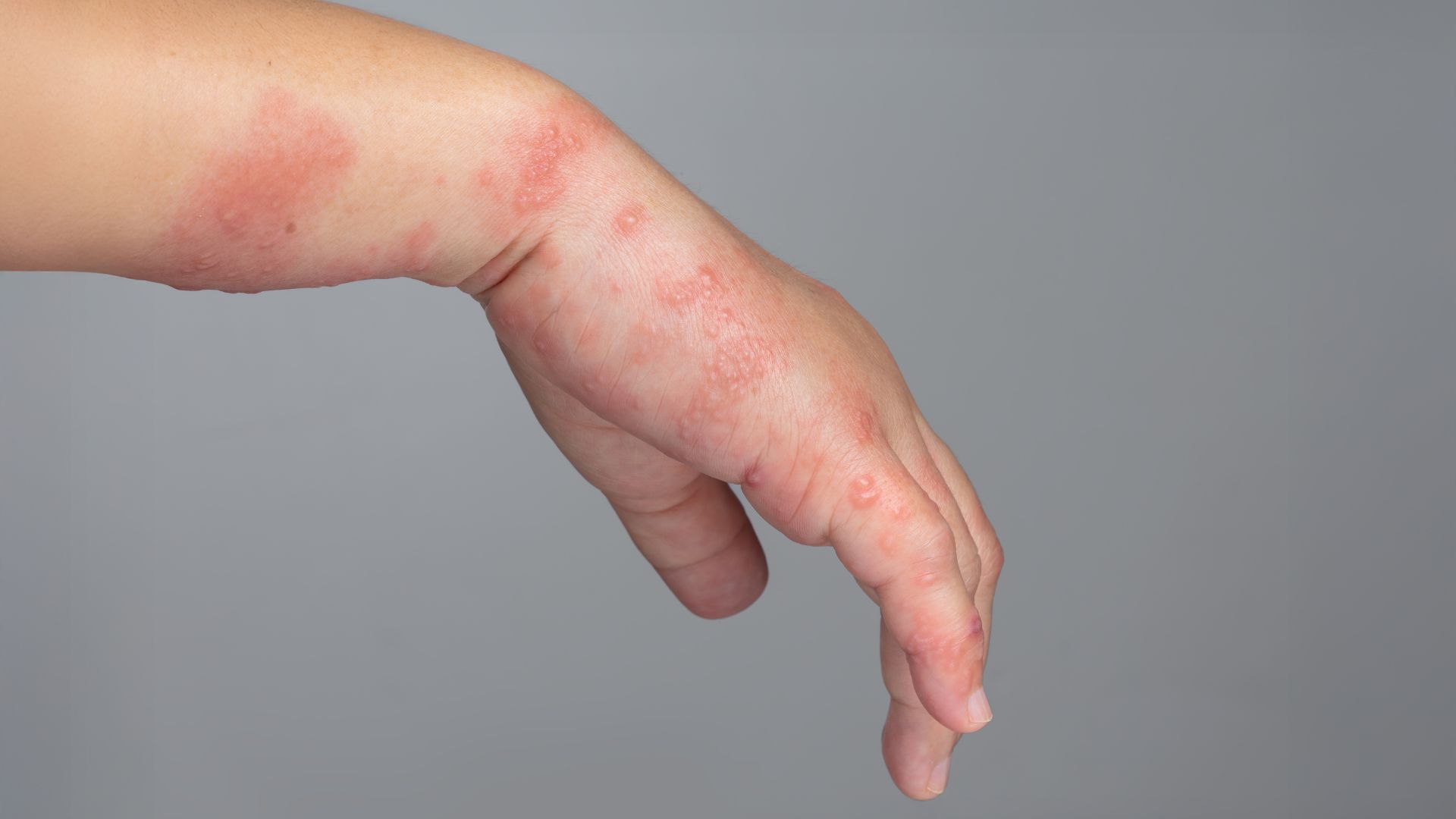 Mụn nước và sẩn đỏ trên da là triệu chứng của ghẻ nước