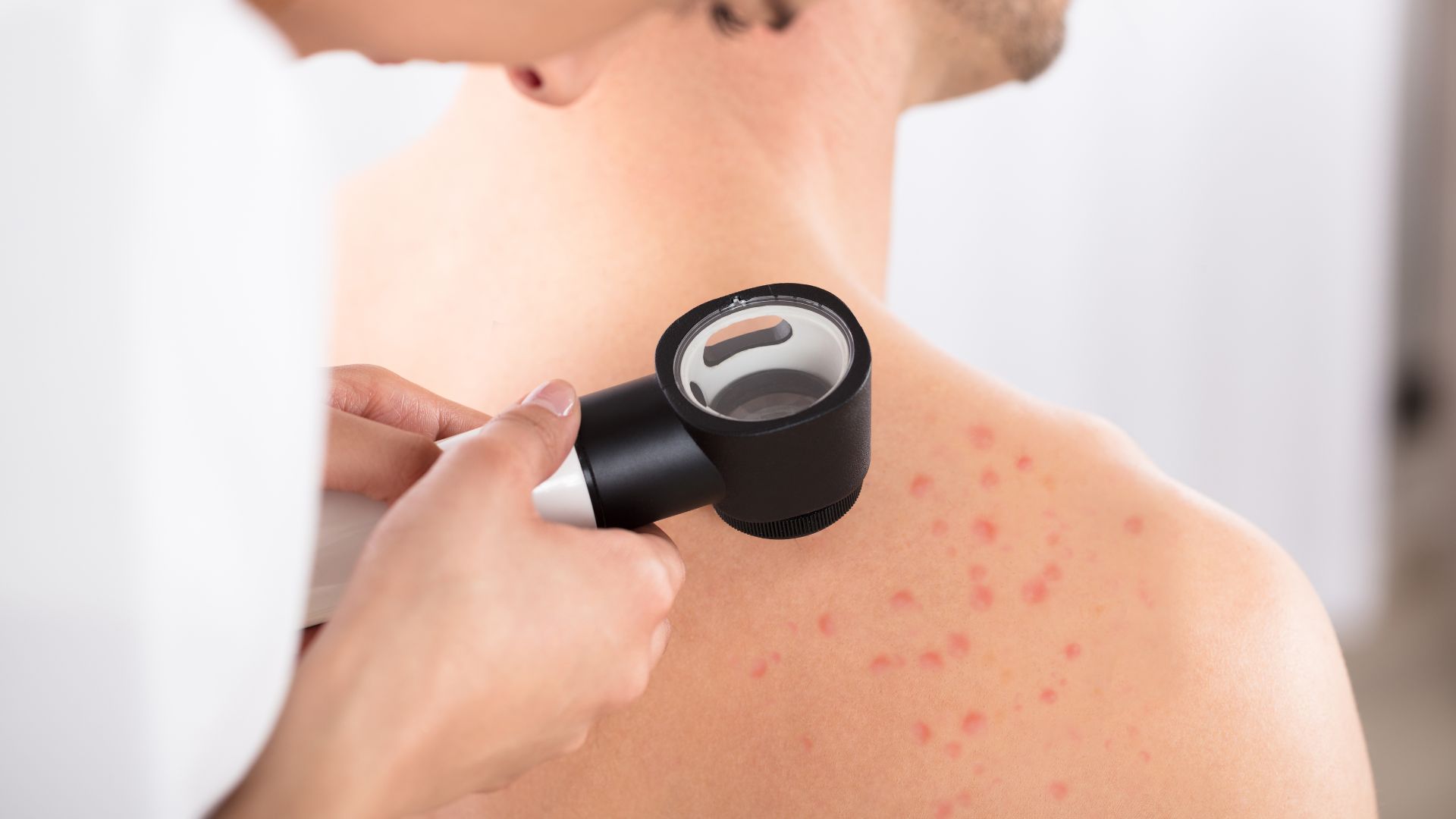 Soi da để quan sát hình ảnh đặc trưng của đường hang ghẻ và ve ghẻ ngay trên bề mặt da, giúp chẩn đoán nhanh, ít xâm lấn