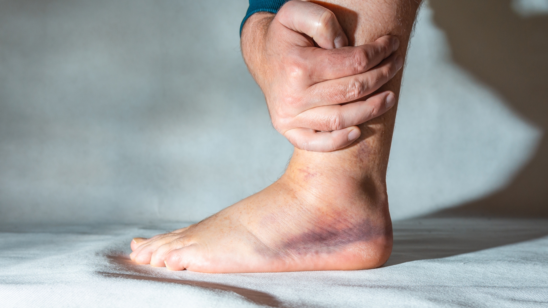 Bầm tím là hậu quả của tình trạng xuất huyết dưới da do tổn thương các mạch máu nhỏ, thường gặp trong các mức độ tổn thương trung bình đến nặng