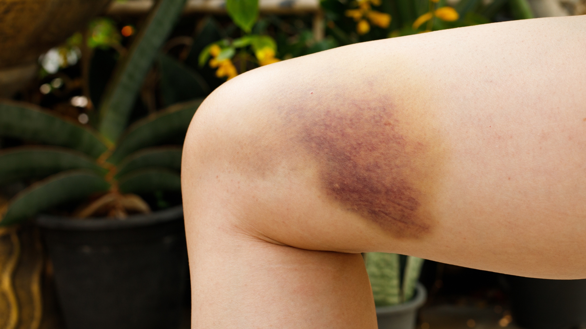 Chỉ với va chạm nhẹ, người mắc bệnh Hemophilia cũng có thể xuất hiện các vết bầm lớn dưới da