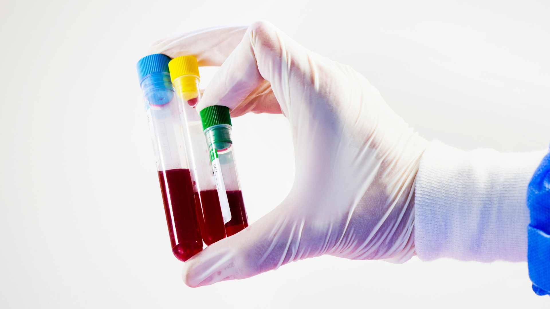 Định lượng yếu tố đông máu VIII và IX là xét nghiệm quan trọng nhất để xác định chính xác loại Hemophilia