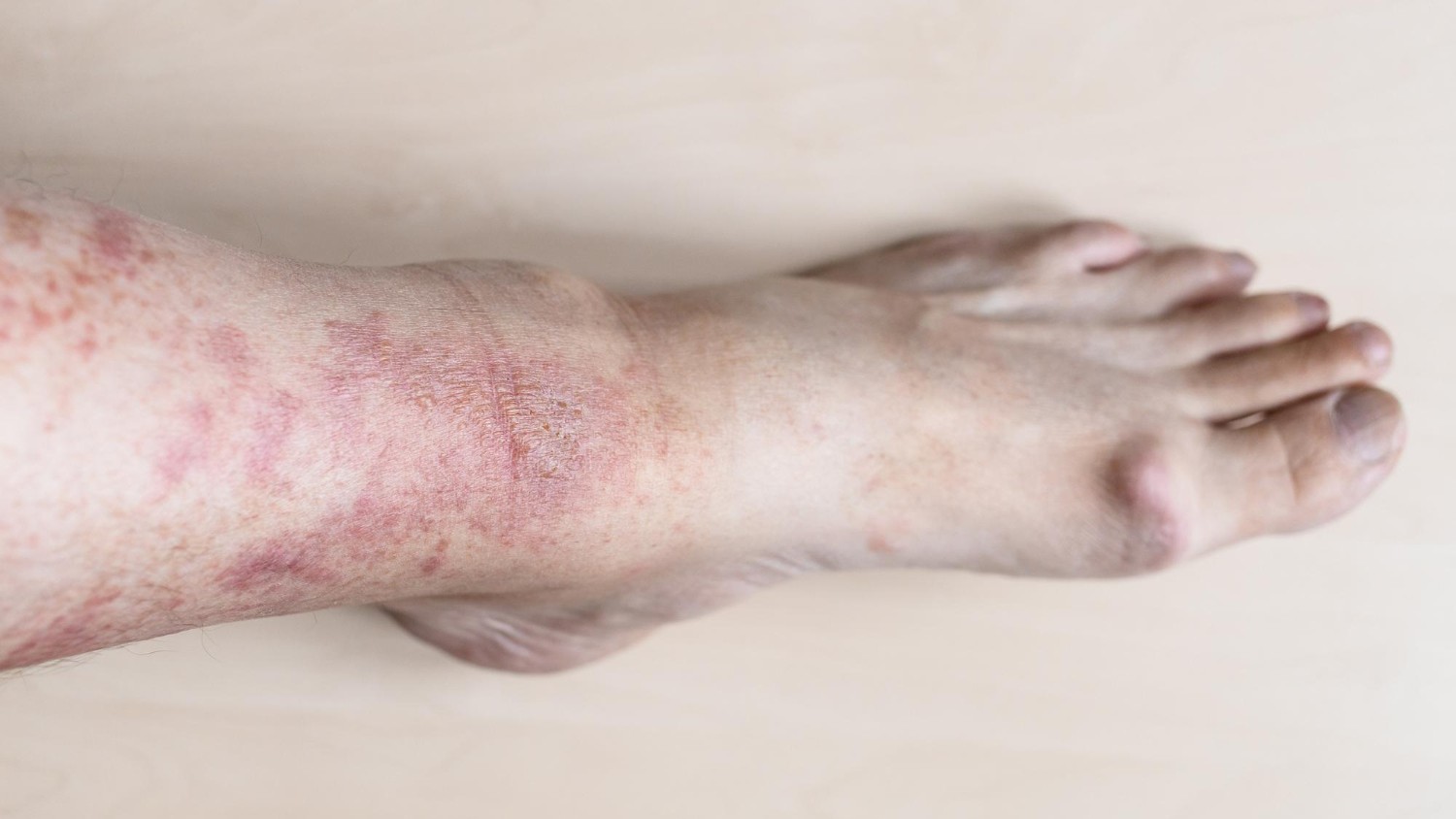 Hồng ban nút có dạng sẩn hoặc u cục màu đỏ xuất hiện trên da, thường gặp vùng cẳng chân