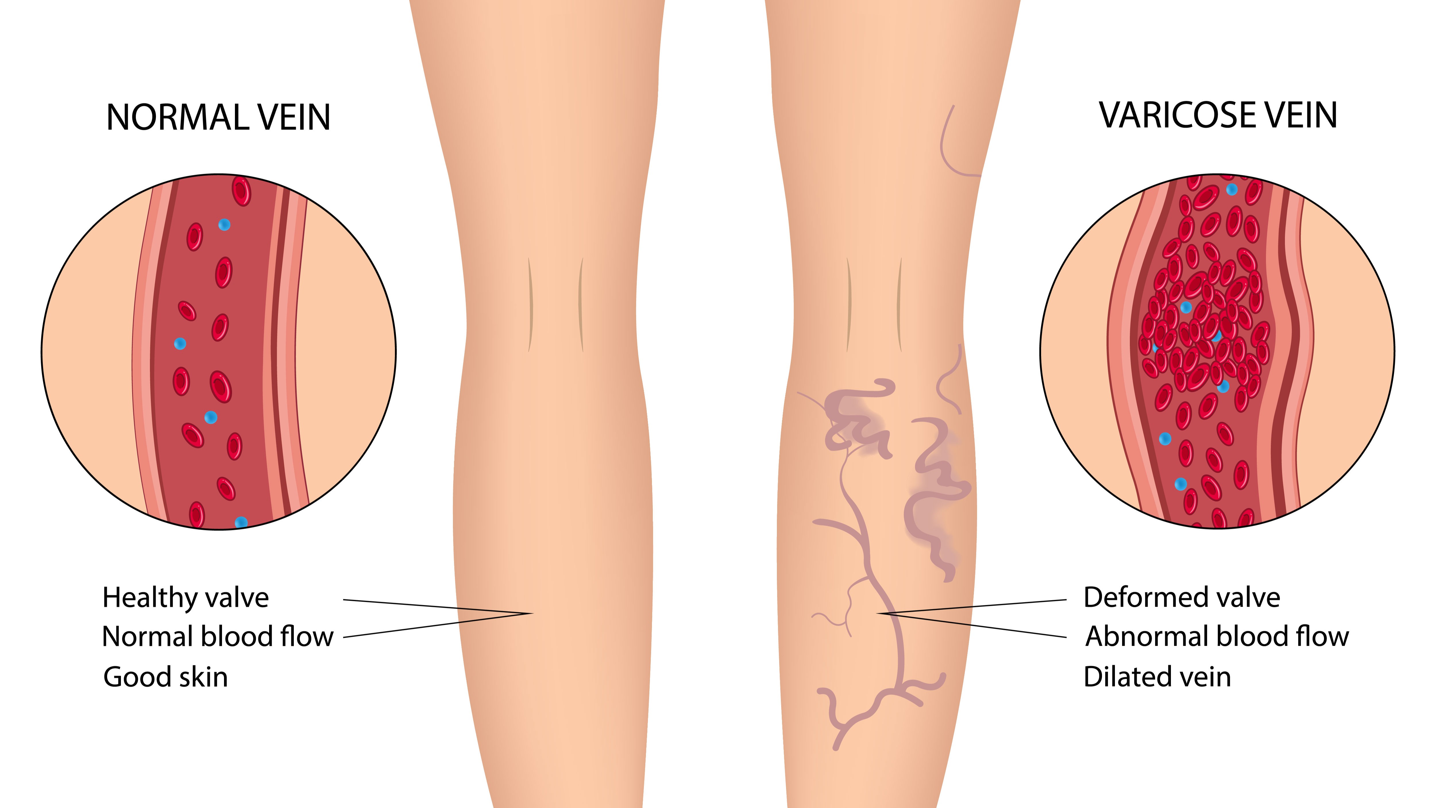 Cục máu đông hình thành một cách bất thường gây ra huyết khối tĩnh mạch
