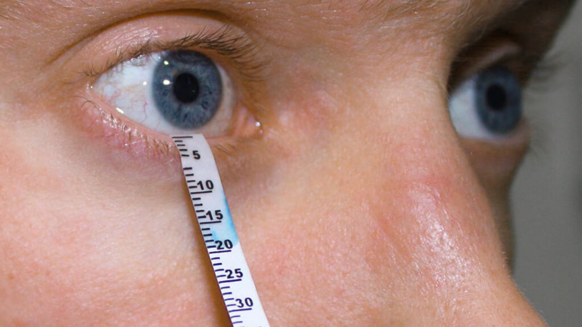 Test Schirmer là phương pháp đơn giản nhằm đo lượng nước mắt tiết ra