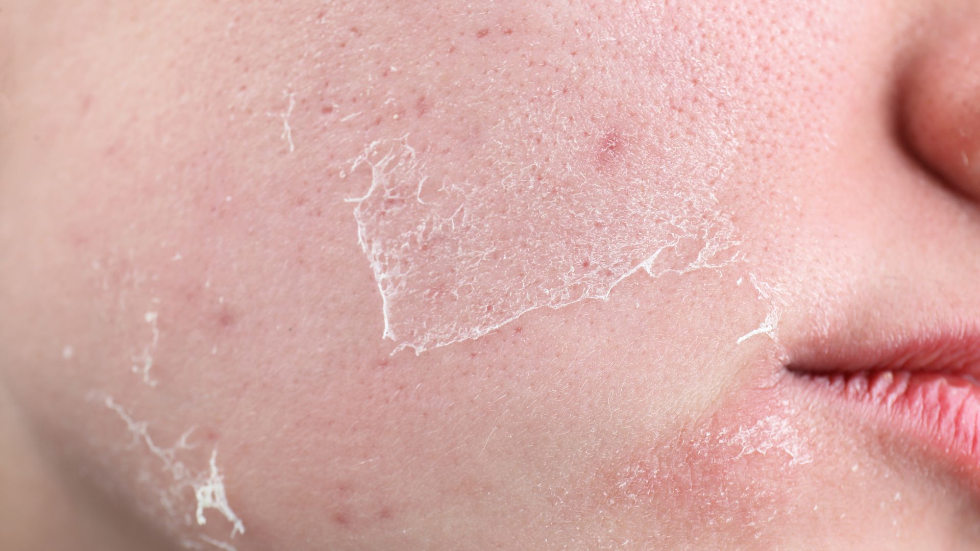 Da khô kéo dài làm da dễ nứt nẻ, giảm khả năng bảo vệ và tạo điều kiện cho các tác nhân kích thích xâm nhập