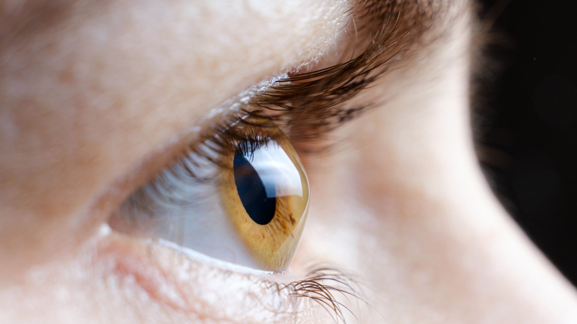 Bất thường độ cong của giác mạc là nguyên nhân phổ biến nhất gây loạn thị.